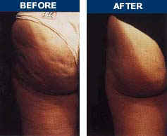 Endermologie Before & After Photo 2