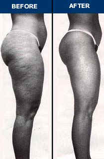 Endermologie Before & After Photo 5