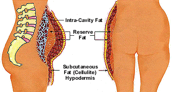 Cellulite Diagram