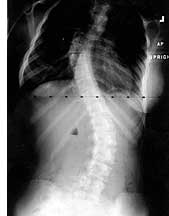 Scoliosis